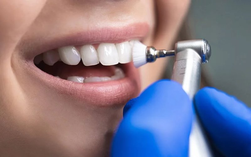 Diş Taşı (Tartar) Tedavisi - Atadent Bursa Diş Polikliniği