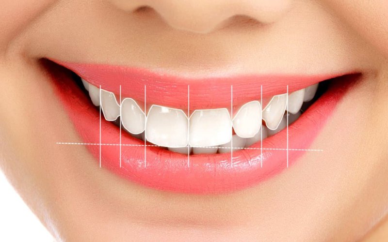 Gülüş Tasarımı - Atadent Bursa Diş Polikliniği