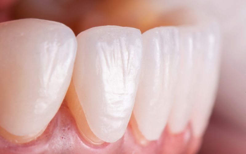 Lamine (Yaprak Porselen) - Atadent Bursa Diş Polikliniği