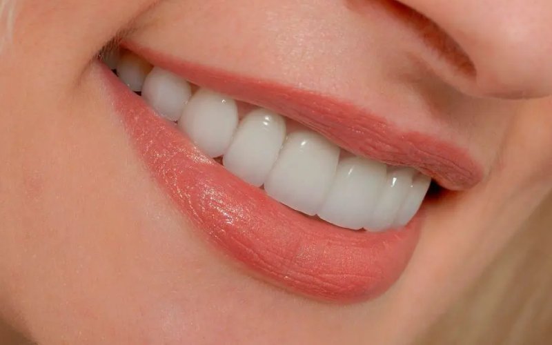 Porselen Diş (Kaplama) - Atadent Bursa Diş Polikliniği